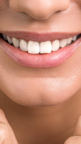 Blanchiment dentaire