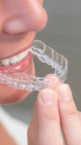 Orthodontie invisible