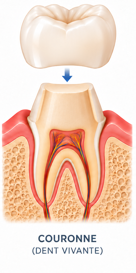 Diagram of a ceramic crown on a living tooth