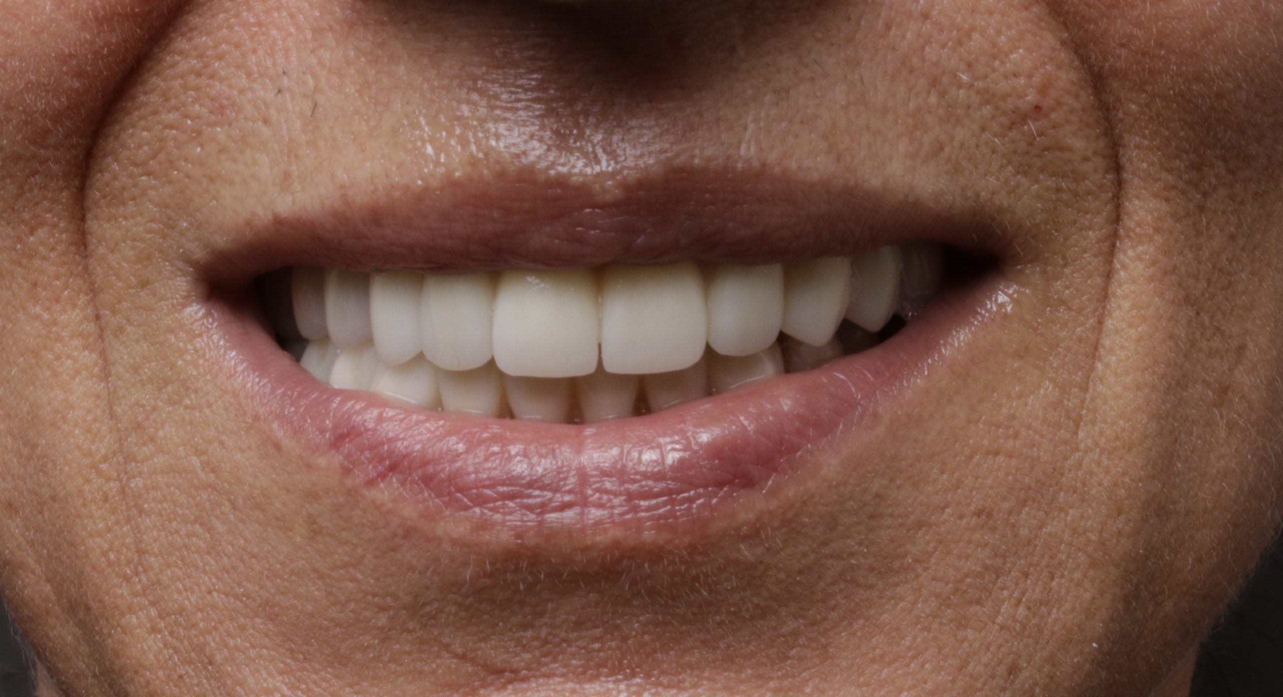 Sourire restauré par un bridge de contention parodontale en céramique, qui solidarise les dents entre elles