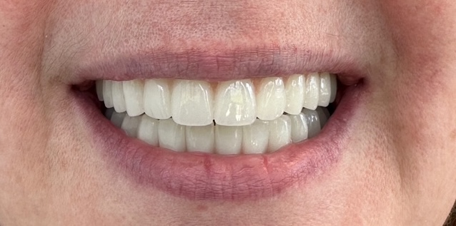 Smile restored with a fixed implant bridge