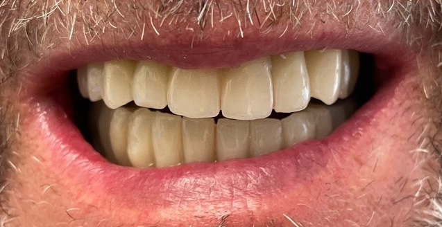 Mit festsitzenden Vollbrücken auf Implantaten wiederhergestelltes Lächeln, oben und unten