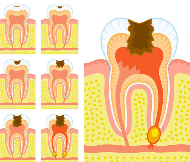 Carie — Comment éviter les caries ?