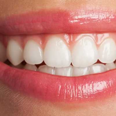 Dent — Comment garder mes dents blanches ?