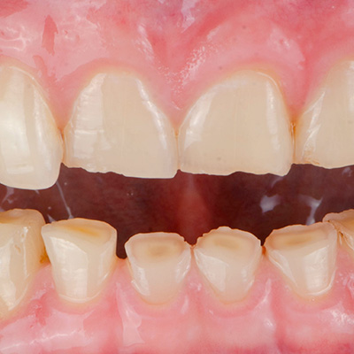 Dents blanches — Comment éviter que mes dents ne s’usent ?
