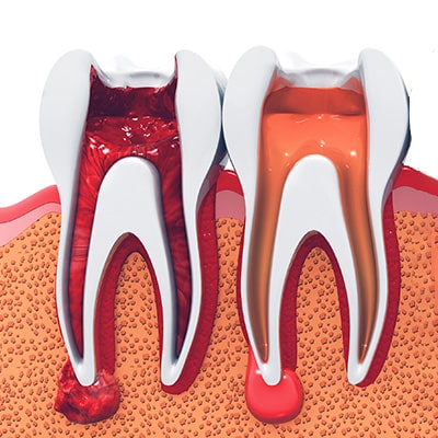 Endodontie — Traitements endodontiques