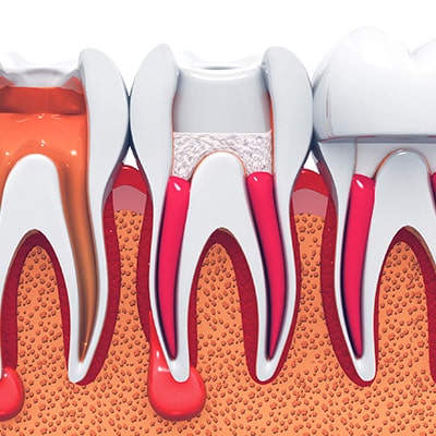 Endodontie — Traitements endodontiques