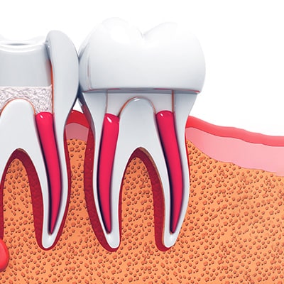 Endodontie — Traitements endodontiques