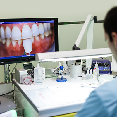 Facettes — Comment fonctionne la pose d’une facette dentaire ?