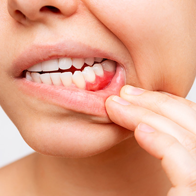 Gencives — Que faire si ma gencive saigne ?
