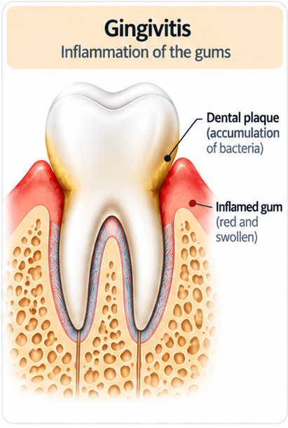Diagram of gingivitis: dental plaque at the gum line and red, swollen gum