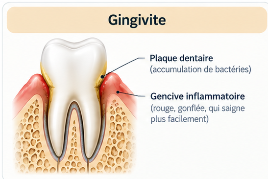 Schéma de la gingivite : plaque dentaire au collet de la dent et gencive rouge, gonflée, qui saigne facilement