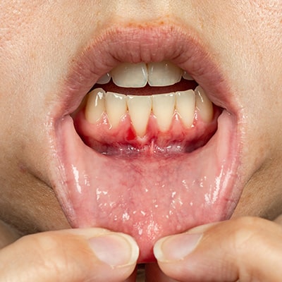 Greffe gingivale — Greffes gingivales