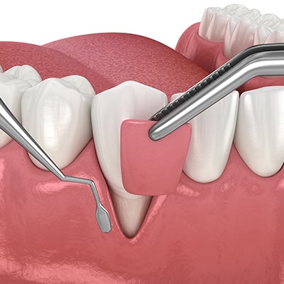 Greffe gingivale — Greffes gingivales