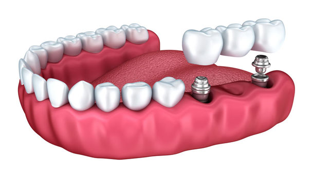 Implants — Passer d’une prothèse amovible à des dents fixes en 1 jour, comment ça marche ?